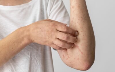 Psoriase: Guia Completo para Compreender e Enfrentar essa Doença